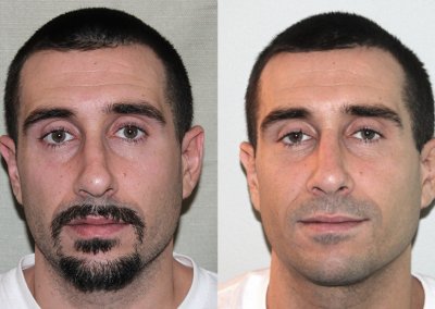 Male Septoplasty NYC