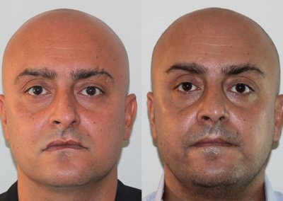 Turbinate Reduction Male