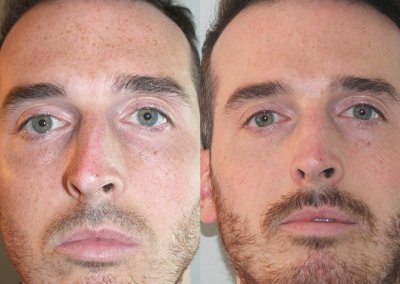 Septoplasty Male New York