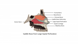 saddle nose deformity from septal perforation