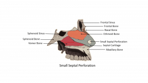 small septal perforation graphic